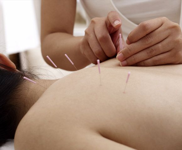 Acupuncture at Natural Therapy Wellness Center
